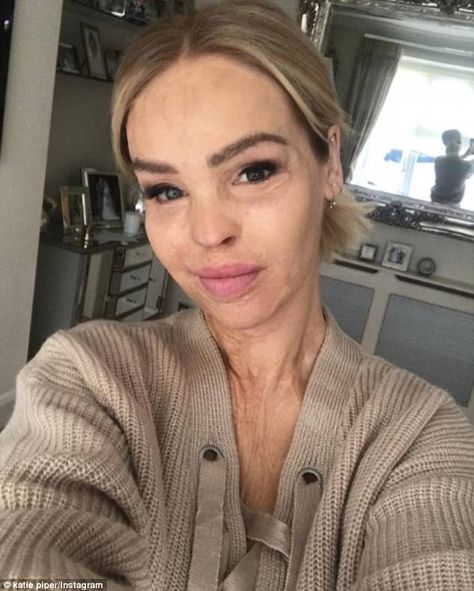 Acid Attack, Katie Piper, Face And Body