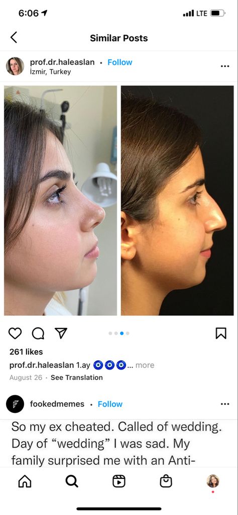 Round Face Nose Job, Button Nose Nose Job, Round Nose Rhinoplasty, Nose Job Thick Skin, Refined Tip Rhinoplasty, Thick Skin Bulbous Tip Rhinoplasty, Rhinoplasty Bulbous Tip, Nose Types, Nose Jobs