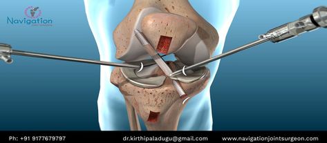 Arthroscopy ACL surgery is keyhole surgery to replace or repair a torn ligament. It is commonly referred to as keyhole surgery.  #ligamenttear #aclreconstructionsurgery #kneearthroscopy #shoulderarthroscopy #arthroscopyofknee #arthroscopymeaning Acl Reconstruction Surgery, Ankle Injuries, Knee Ligaments, Acl Surgery, Anterior Cruciate Ligament, Ligament Tear, Ligament Injury, Cruciate Ligament, Knee Replacement Surgery