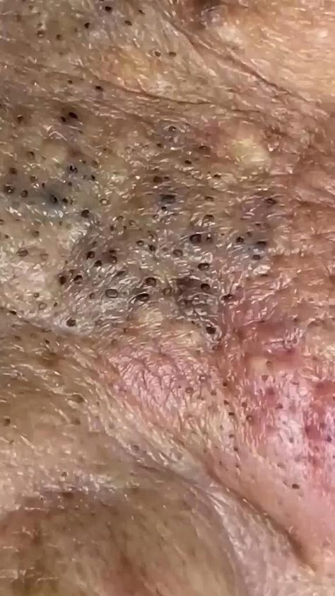 Effortless Blackhead Removal: The One-Step Secret #Blackheads #skincare #blackheadremoval #cleanser #facecleanser #beautyhacks #NaturalMedicineRemedies Black Head Removal Video Nose, Huge Blackheads, Black Heads Removal Video, Satisfying Zit Popping Videos, Popping Pimples, Blackheads On Face, Clear Skin Fast, Blackhead Extraction, Blackhead Remedies