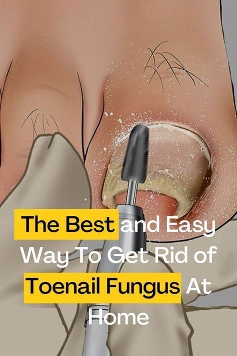 Toenail Problems, Fungal Infection Remedies, Toenail Health, Toenail Fungal Infection, Nail Remedies, Toenail Fungus Remedies, Nail Fungus Remedy, Nail Infection, Fungal Nail