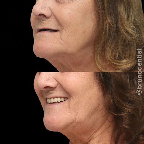 Dentures Before And After, Dental Implants Before And After, Facial Profile, Dental Animation, Affordable Dentures, Dental Implant Procedure, Dental Implant Surgery, Dental Implants Cost, Oral Surgeon