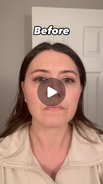 6 likes, 2 comments - dr.jessicaburgy on March 27, 2024: "My before and after photos from laser resurfacing! 💫 I love the results and plan on doing this once a year to keep my skin glowing....". Skin Resurfacing Before And After, Laser Skin Resurfacing, Laser Resurfacing, Skin Resurfacing, Skin Glowing, Laser Therapy, March 27, After Photos, My Skin