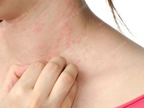 Eczema On Neck - How To Get Rid of Neck Eczema? Alcohol Intolerance, Color Of Urine, Heat Rash, Itching Skin, Allergy Symptoms, Dr Oz, Abdominal Pain, Skin Conditions, Health Remedies