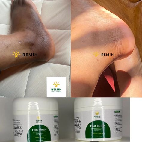 REVIEW O'CLOCK Customer: I used to hide my feet in shoes all the time. Dark spots and rough skin made me feel insecure, especially during sandal season. But then, I found Remih Foot Butter. Within just a few weeks, my feet became softer than ever, and the dark spots faded away! Now, I walk confidently barefoot—no more hiding. If you’re struggling with dry, rough feet or hyperpigmentation, this is your answer! Remih Foot Butter is guaranteed to clear dark spots and soften your feet, or you ... Clear Dark Spots, Walk Confidently, Kojic Acid Soap, Feeling Insecure, Kojic Acid, Rough Skin, O Clock, Dark Spots, Home Remedies