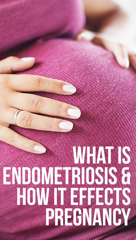 What Is Endometriosis & How It Effects Pregnancy Diet While Pregnant, Endo Diet, Pregnancy Nutrition, Mom Junction, Conceiving, Get Pregnant, Morning Sickness, Staying Healthy, Pregnancy Symptoms