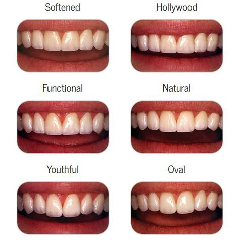 Cosmetic Dentistry - Los Angeles Cosmetic Dentistry - Culver City Cosmetic Dentistry - Centurysmile.com Teeth Makeover, Dental Makeover, Cosmetic Dentistry Veneers, Toothy Smile, Cosmetic Dentistry Procedures, Teeth Whitening Homemade, Dental Health Care, Veneers Teeth, Beautiful Teeth