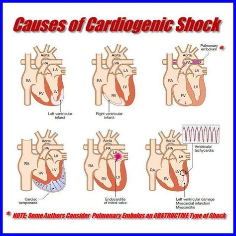 Causes of Cardiogenic Shock Nurse Knowledge, Nursing Hacks, Emt Study, Cardiogenic Shock, Paramedic School, Visual Learner, Nursing Information, Nursing Mnemonics, Pa School