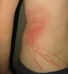 TheSoapCafe`: How to ease the pain of a stinging Jelly Fish -The natural way Jellyfish Sting Remedy, Jellyfish Species, Jellyfish Sting, Myrtle Beach Vacation, Beach Vacay, Jelly Fish, Beach Hacks, Whiplash, Read News