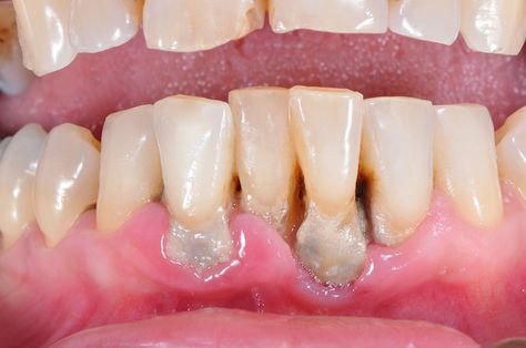 Gum Disease - Cause & Prevention Dental Health Care, Oral Surgeon, Teeth Health, How To Prevent Cavities, Periodontal Disease, Receding Gums, Gum Health, Teeth Care, Cosmetic Dentistry