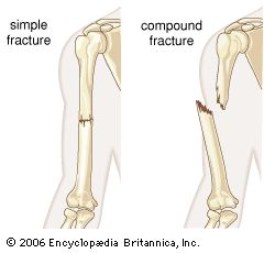 Research shows smoking harms your chances of recovering from fractures. Bone healing cells in non-smokers are of a better quality, more active and quicker at dividing than those of smokers, according to new research carried out by United Lincolnshire Hospitals NHS Trust (ULHT) and the University of Lincoln, UK, Open Fracture, Types Of Fractures, Fracture Healing, Bone Drawing, Femur Bone, Bone Healing, Types Of Bones, Arm Bones, Bone Fracture