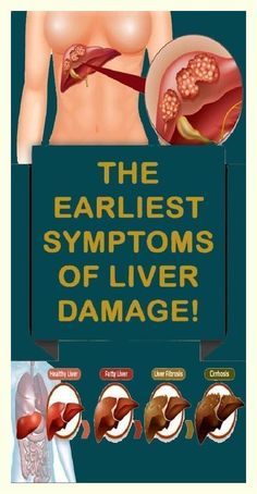 This is a warning sign for a damaged liver. Do not ignore! Health Resolutions, Liver Damage, Take Care Of Your Body, Healthy Liver, Stomach Pain, Healthy Beauty, Years Younger, Stubborn Belly Fat, Warning Signs