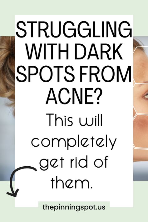 Looking for a solution to dark spots from acne? Dive into our blog post to uncover effective treatments and remedies. From creams to overnight solutions, we've curated the best methods to fade dark spots and marks away to reveal brighter, clearer skin. Say goodbye to uneven skin tone & hello to confidence with our expert tips and recommendations.  Dive into our blog post to uncover the secrets to eliminating dark spots caused by acne. Say goodbye to blemishes & dark spots on your face from acne How To Lighten Acne Marks, Lighten Dark Spots On Face, How To Get Rid Of Brown Spots On Face, Get Rid Of Acne Marks Dark Spots, Baking Soda Face Mask Dark Spots, Acne Dark Spots Remedies, How To Get Rid Of Scars From Acne, Dark Spots On Face Remedies, Fade Dark Spots On Face