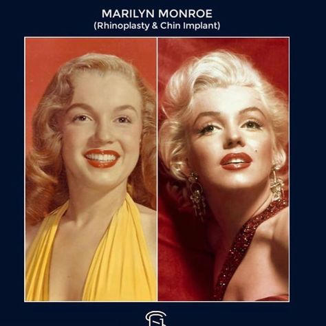 Jessica Manges ARNP Aesthetic on Instagram: “Marilyn Monroe had a rhinoplasty and chin implant which gave her the iconic look we remember her today by. Beauty icons throughout history…” Marilyn Monroe Nose Job, Chin Implant Before And After, Marilyn Monroe Plastic Surgery, Chin Implant, Facial Plastic Surgery, Facial Aesthetics, Celebrity Plastic Surgery, Reconstructive Surgery, Facial Plastic