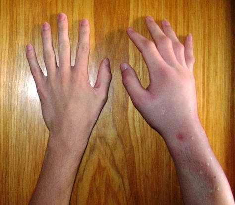 What To Do For A Bee Sting Bee Sting Remedy, Bee Sting Swelling, Bee Sting Relief, Wasp Sting Remedy, Swelling Remedies, Remedies For Bee Stings, Swollen Hands, Sting Relief, Wasp Stings