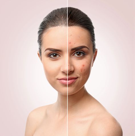 Pimple Face, Before And After Acne, Ayurveda Tips, Ayurveda Beauty, Hair Poster, Ayurvedic Skin Care, Pimples Under The Skin, Post Cover, Pimples On Face