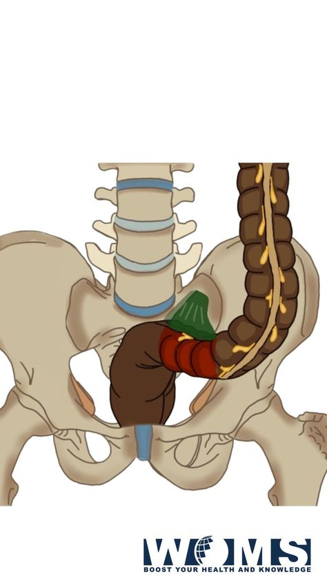 The sigmoid colon is also known as the pelvic colon due to its presence in the pelvic region. It is the last part of the large intestine nearest to the rectum and anus. It is the point where feces stays for a while before getting excreted. The sigmoid colon maintains a continuation from the descending colon to the rectum. It is usually present within the pelvis area. But, it often becomes displaced into the abdominal cavity due to its mobility. Colon Anatomy, Sigmoid Colon, Pelvic Region, Large Intestine, Anatomy, Conditioner