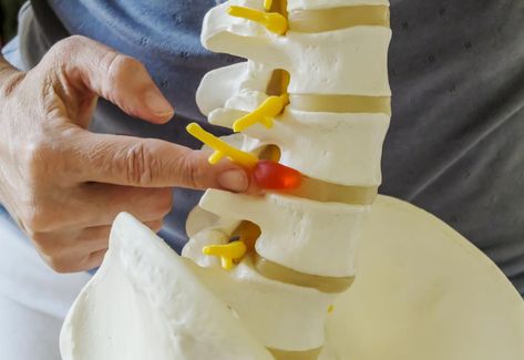 Disc desiccation: Symptoms, causes, exercises, and treatments Lumbar Disc, Intervertebral Disc, Bulging Disc, Spinal Nerve, Spinal Injury, Musculoskeletal System, Spine Health, International Conference, Bones And Muscles