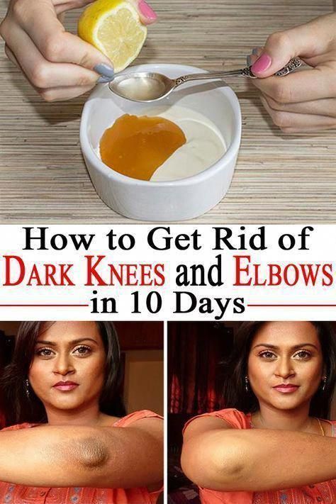 Dark Knees And Elbows, Dark Knees, Skin Hacks, Dark Elbows, Beauty Natural, Beauty Remedies, Body Scrubs, Skin Remedies, Shaved Sides