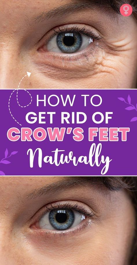 Best Eye Wrinkle Cream Crows Feet Anti Aging, How To Get Rid Of Crows Feet Eye, Eye Wrinkles Get Rid Of, Crows Feet Remedies, Crows Feet Wrinkles How To Get Rid, Facial Remedies, Crows Feet Wrinkles, Home Remedies For Wrinkles, Face Treatments