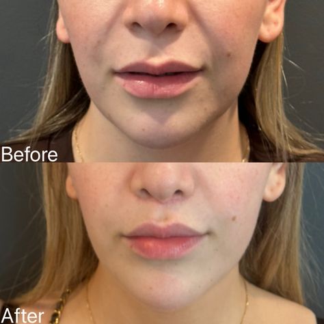 I had the absolute pleasure of seeing this beautiful bride-to-be for her 2 month follow-up. 👰‍♀️ We did a subtle upper lip lift to balance out her facial features and reveal more of her natural volume. The scar is a little pink as expected in this stage of healing, and will keep improving over the next few months. We are so excited for her next big chapter! #liplift #subnasalliplift #upperliplift Upper Lip Lift, Lip Lift, Upper Lip, Facial Features, Beautiful Bride, So Excited, Facial, The Next, Lips