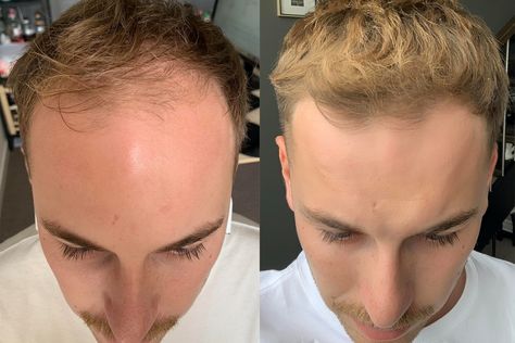 There was a time when the fight against hair loss was an uphill battle, and men would surrender to balding. But before you reach for the razor or hide your head under a hat, it’s worth considering the options. Below are three real-life stories of […]Visit Man of Many for the full post. Thinning Hair Hairstyles Men, Hair Lossing Tips Men, Thinning Hair Men, Balding Mens Hairstyles, Short Hair Outfits, High Forehead, Receding Hair Styles, Mens Hair Care, Hair Issues