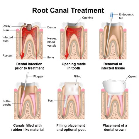 Apex Dental P.A. is a rock hill, SC based Dental clinic. We have general dentist, specialty in endodontists such as Root Canal, Implants, Cosmetic dentistry, painless dentistry, pediatric dentistry, Whitening, Teeth cleaning. For More Information Visit Our Website: - https://www.apexdentalpa.com/ Dental Assistant Study, Dental Posters, Dental Facts, Laser Teeth Whitening, Dental Bridge, Tooth Pain, Dental Crowns, Dental Procedures, White Lily