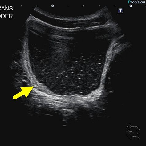 Transverse ultrasound of the urinary bladder in a patient with hemorrhagic cystitis shows considerable debris within the bladder and… Abdominal Ultrasound, Pregnancy Tattoo, Urinary Bladder, Medical Sonography, Ultrasound Sonography, Medical Ultrasound, Diagnostic Medical Sonography, Belly Painting, Urinary Tract