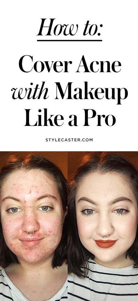 How to Cover Acne with Makeup (Like a Pro!) | This woman's before-and-after photo is living proof that you can flawlessly conceal even the worst breakouts | @stylecaster Cover Acne With Makeup, How To Cover Pimples, Acne With Makeup, Acne Concealer, Covering Acne, Lotion For Oily Skin, Acne Makeup, Post Inflammatory Hyperpigmentation, Tips For Oily Skin