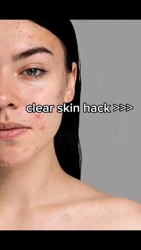 CLEAR SKIN HACK>>> Clear Skin Face Mask, Best Skincare Routine, Skin Face Mask, Face Skin Care Routine, Skincare Secrets, Clear Skin Face, Skin Care Routine Order, Natural Face Skin Care, Diy Skin Care Routine