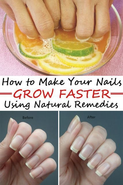 Remedy That Makes Your Nails Grow Faster in Just 8 Days | My-FavThings | Bloglovin’ Nails Grow Faster, Make Nails Grow, Grow Long Nails, Grow Nails Faster, Transparent Nails, How To Grow Nails, Brittle Nails, Nail Growth, Strong Nails