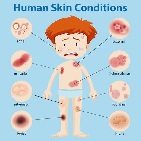 Skin diseases Vectors | Free download Diy Natural Detergent, Dermatology Clinic, Face Pores, Types Of Acne, Acne Causes, Character Cartoon, Skin Disorders, Skin Cleanse, Skin Diseases