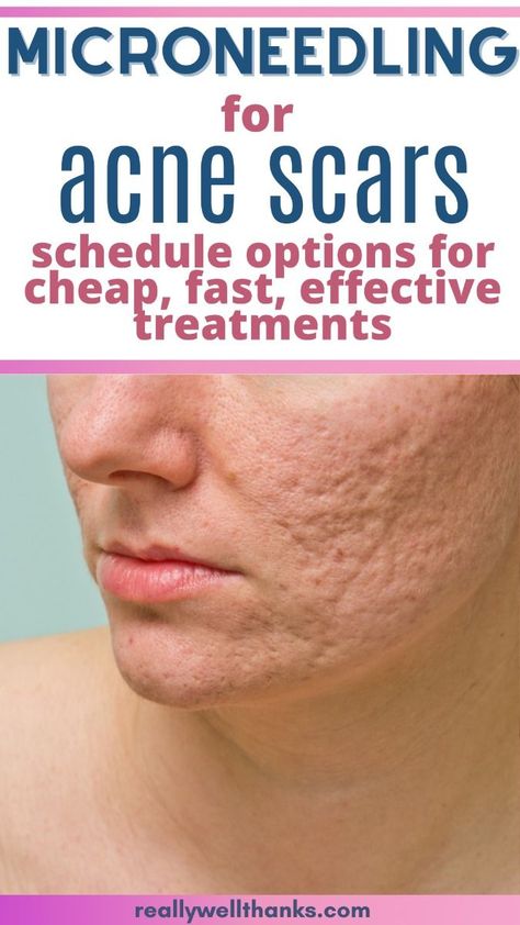 Acne Scar Microneedling - How Many Treatments? Micro Needling Before And After, Microneedling Before And After, Microneedling At Home, Best Acne Scar Removal, Face Mapping Acne, Moderate Acne, Micro Needling, Acne Scarring, Acne Face Mask