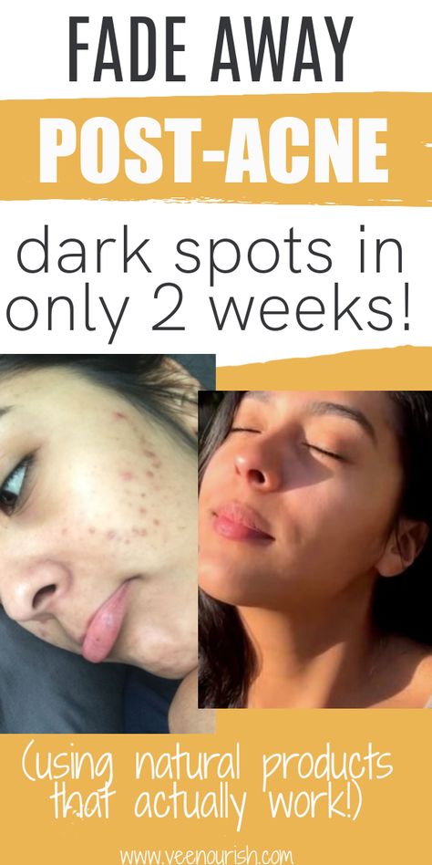 Post Acne Dark Spots Removal | How To Get Rid Of Acne Scars & Hyperpigmentation On Face Face Pack For Acne Spots, Lip Acne Remedies, Dark Spots On Face From Acne, How To Get Rid Of Dark Spots On Face Diy, Best Skin Care Products For Acne Dark Spots, How To Get Rid Of Acne Spots On Face, Dark Acne Spots Remedies, How To Get Rid Of Acne Spots, How To Get Rid Of Hyperpigmentation Skin