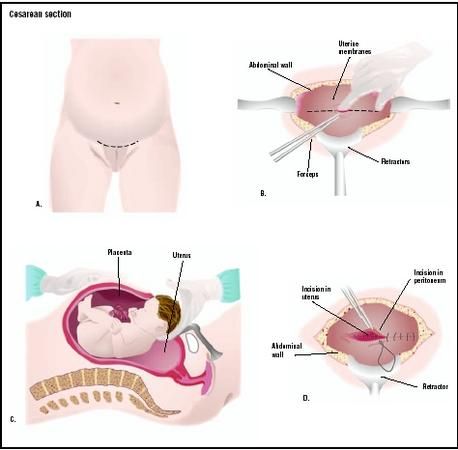 Cesarean section (LSCS): Operative procedure ~ MedchromeTube - Best Medical Videos Placenta Abruption, Disseminated Intravascular Coagulation, Cranial Nerves Mnemonic, Abdominal Aorta, Subclavian Artery, Cesarean Section, Surgical Technologist, Baby Check, Facial Nerve