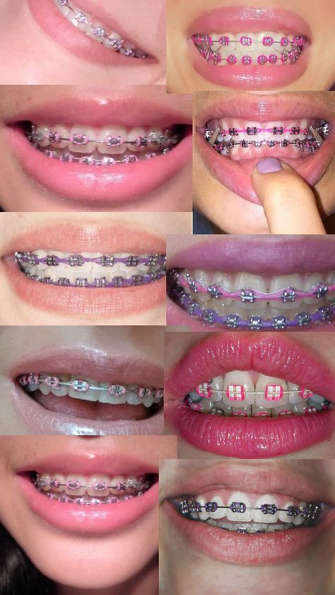 Dental Braces Colors, Braces Colors Combinations, Pink Braces, Cute Braces Colors, Teeth Aesthetic, Pretty Teeth, Braces Tips, Getting Braces, Cute Braces