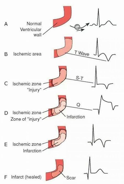 Myocardial infarction Medical Diagrams, Paramedic School, Nursing Information, Penyakit Jantung, Cardiac Nursing, Nursing School Survival, Nursing School Studying, Nursing School Tips, Nursing School Notes