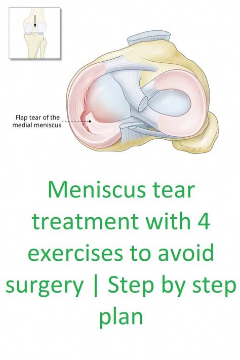 #HerbsForNervePainRelief Meniscus Root Tear Recovery, Torn Medial Meniscus Exercises, Meniscus Surgery Recovery, Meniscus Surgery, Knee Meniscus, Knee Workout, Exercises For Knee Pain, Knee Pain Relief Remedies, Knee Exercise