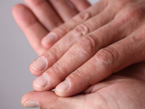 A narrow, vertical black line on your nail is called a splinter hemorrhage. On the other hand, lines that create a horizontal stripe are called Beau's lines. Both conditions that appear as black lines on nails are generally harmless, although they can both signify a more serious underlying condition. Learn more now. Horizontal Ridges In Fingernails, Moons On Fingernails, Nail Ridges, Half Moon Nails, Dark Red Nails, Vitamin Deficiency, Makeup Hacks Beauty Secrets, Moon Nails, Lines On Nails