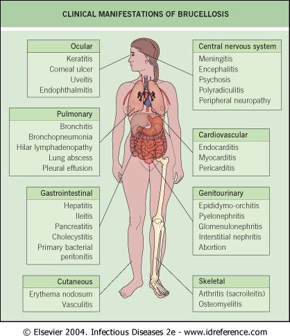 Brucellosis - inflames just about every organ in your body apparently... 12 Organ Systems, Cell Tissue Organ Organ System Organism, Abdominal Regions And Organs, Community Medicine, Internal Organs Diagram, 11 Major Organ Systems, Medical Diagrams, Pleural Effusion, Bacterial Diseases