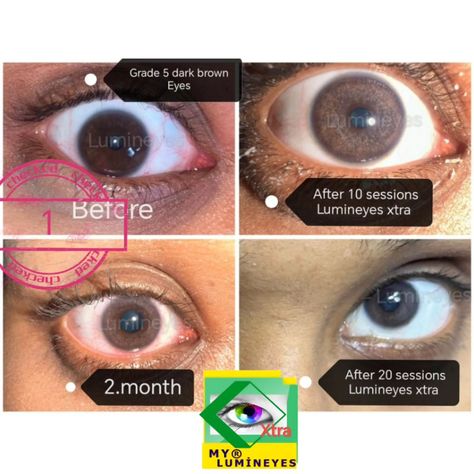 Changing eye color by Lumineyes Xtra laser procedure provides natural and healthy results, even in grade 5 dark brown eyes.... The only non-risky eye color change surgery by laser is "Lumineyes"! https://mylumineyes.com/ #lumineyes #canyouchangeyoureyecolor #drmustafamete #changingeyecolor #changeeyecolor #eyecolors #lasereyecolorchange #mylumineyes Eye Color Change Surgery, White Teeth Tips, Woman Eyes, Teeth Tips, Coordinates Outfits, Laser Eye, Eye Surgery, Brown Eye, Dark Brown Eyes