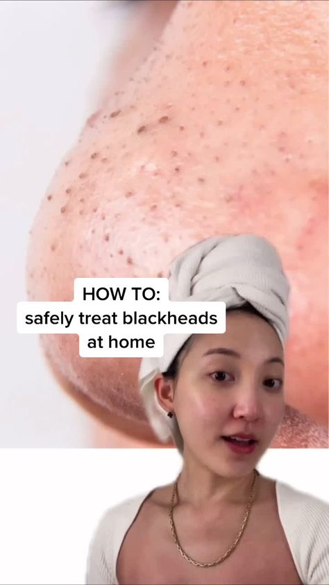 Haut Routine, Skin Advice, Blackheads Removal, Serious Skin Care, Remove Blackheads, Basic Skin Care Routine, Beauty Tips For Glowing Skin, Clear Skin Tips, Healthy Skin Tips