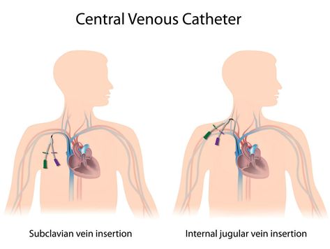 Central Venous Catheter Market Segmentation by Top Companies, Type and Region Catheter Insertion, Central Venous Catheter, Nursing Skills, Nursing Board, Interventional Radiology, Medical Marketing, Central Line, Nursing School Survival, Medical Laboratory Science