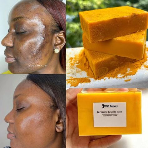 Tumeric And Kojic Soap, Soap For Dark Spots, Glowing Body Skin, Diy Turmeric Face Mask, Organic Turmeric Powder, Orange Soap, Extremely Dry Skin, Turmeric Soap, Natural Acne Remedies