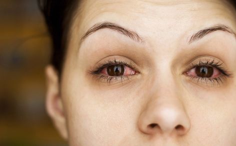 IBD eye problems- Uveitis, Crohn's & ulcerative colitis Bloodshot Eyes, Eye Infections, Pink Eye, Eyes Problems, Eye Drops, Dry Eyes, Puffy Eyes, Pink Eyes, Eye Health