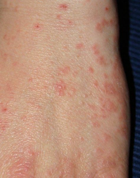 Pinned 03-19-2016:  Atypical Scabies Symptoms: Unusual Symptoms of Mites Doctors Don't Recognize Types Of Bug Bites, Clear Skin Remedies, Bug Bites Remedies, Natural Remedies For Migraines, Bug Bites, Homemade Remedies, Itchy Skin, Home Remedies, Natural Remedies