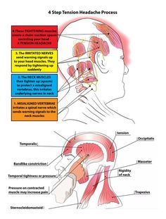 Punkty Spustowe, Tension Headache Relief, Home Remedies For Sinus, Forward Head Posture Exercises, Headache Types, Trigger Point Therapy, Trigger Point, Migraine Relief, Tension Headache