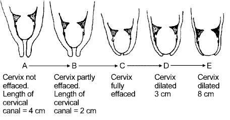 Stage 1 of labor Cervical Dilation Chart, Cervix Dilation Chart, Cervical Effacement, Cervix Dilation, Midwifery Student, Doula Care, Medical Ultrasound, Student Midwife, Baby Delivery