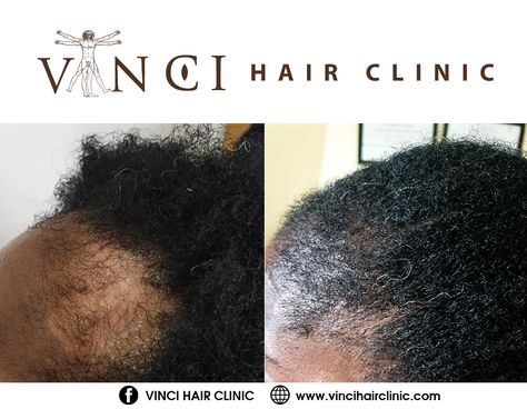 Hair loss is a common hair condition that affects at least 50% of men and women. A handful of factors can cause hair loss among them diet, lifestyle, medication, underlying health issues, hereditary, or even due to mechanical damages either by pulling or tension. This article talks about traction alopecia, a hair loss condition caused by mechanical damages, and how it can be treated or stopped. #alopecia #tractionalopecia Tension Alopecia, Traction Alopecia, Diet Lifestyle, Hair Clinic, Hair Restoration, Stop It, Latest Hairstyles, Hair Care Tips, Health Issues