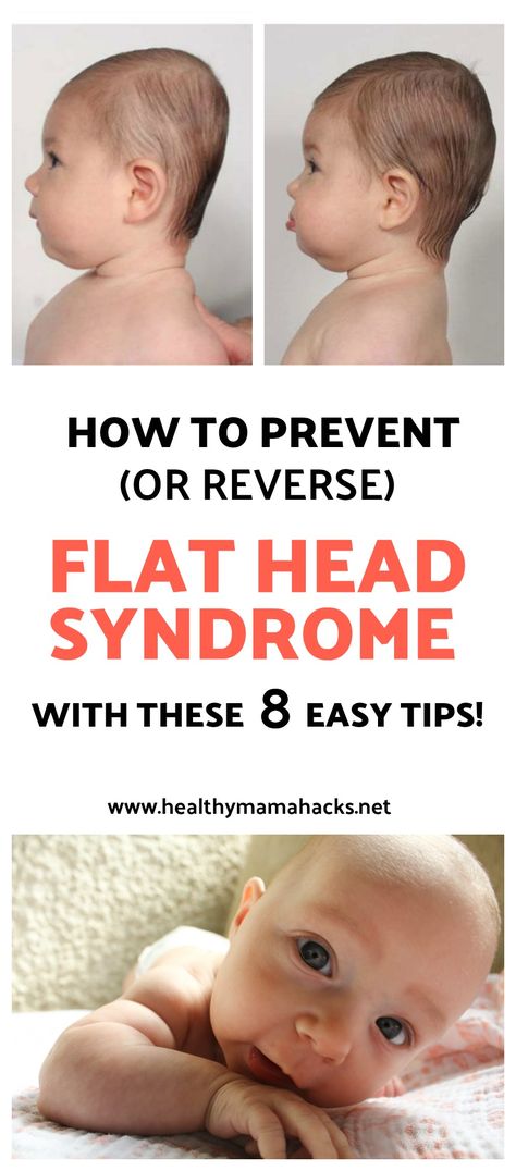 Plagiocephaly: How to Prevent Flat Head in Babies | Healthy Mama Hacks Flat Head Baby, Flat Head Syndrome, Pumping Moms, Fantastic Baby, Baby Sleep Problems, Baby Arrival, After Baby, Baby Supplies, Newborn Care